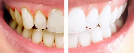 Отбеливание зубов AirFlow фото до и после