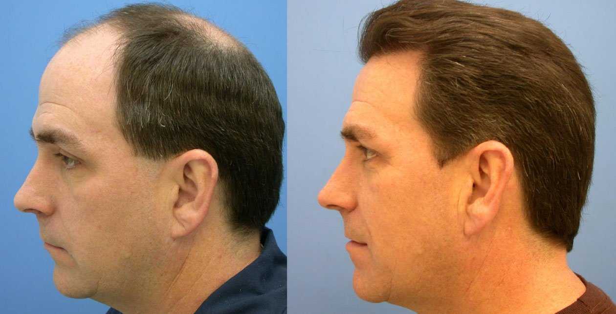 До и после пересадки волос