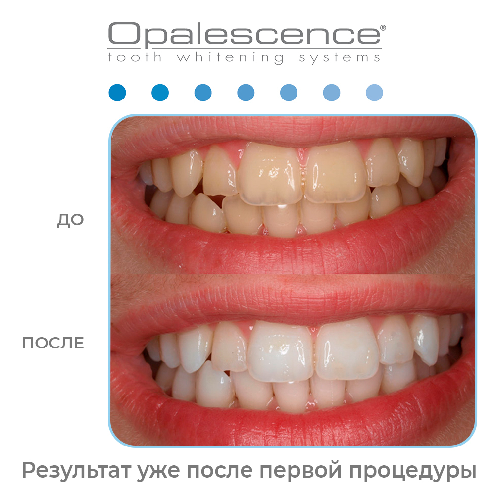 Отбеливание Opalescence Boost цена в Москве — стоматология Трит
