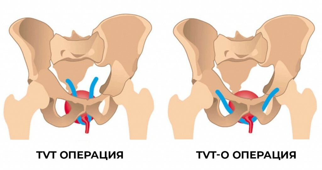 Операция тивити петля фото схема