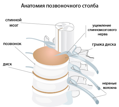 Как лечить грыжу межпозвоночных дисков в Москве