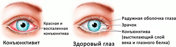 Конъюнктивит глаз лечение у взрослых в Москве