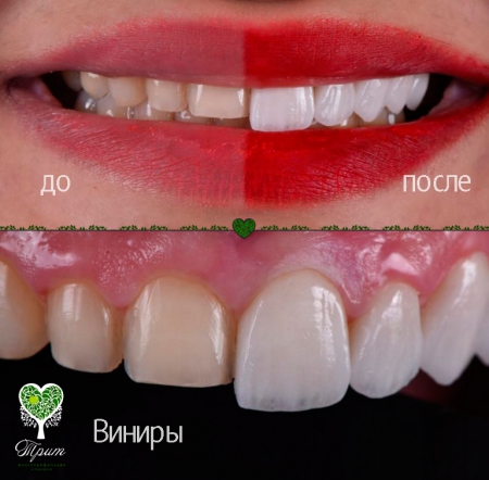 Керамические виниры на зубы фото до и после — цена в Москве