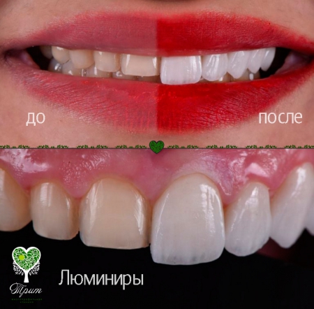 Люминиры на зубы фото до и после плюсы и минусы