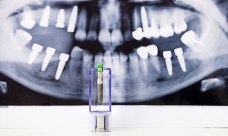 Имплантация зубов AstraTech под ключ стоимость